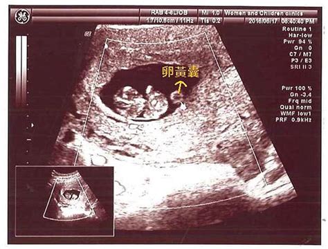 懷孕 十 週 超 音波